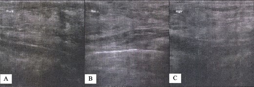 Right breast US findings. (A–C) Fibrocystic disease with cysts.