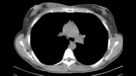 CT indicating heterogeneous enhancement and diffuse thickening of the skin of the right breast.
