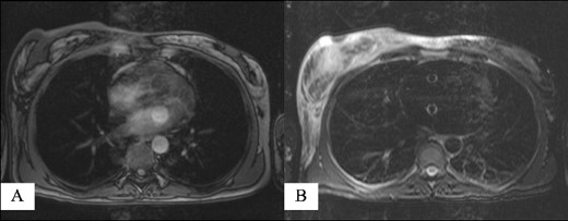 Magnetic resonance imaging reporting an area of 9.6 × 5 × 7.3 mm in the right breast enhanced by contrast uptake: (A) T1-weighted sequence and (B) T2-weighted sequence.