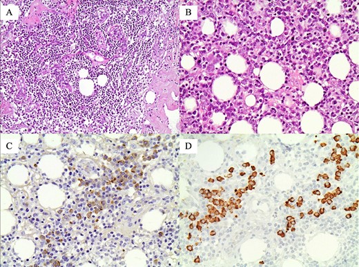 Histopathological findings, highly suggestive of IgG4-related sclerosing mastitis (IgG4-RSM): (A) Atrophic lobule with dense lymphoplasmacytic infiltration (original magnification ×200); (B) dense lymphoplasmacytic infiltration in the adipose tissue (original magnification ×400); (C) many IgG(+) plasmatocytes (original magnification ×400); and (D) more than 50 IgG4(+) plasmatocytes in this HPF (original magnification ×400).