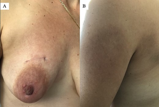 Since the mass excision, the skin lesions persisted: (A) right breast 20 days postoperatively and (B) left arm.