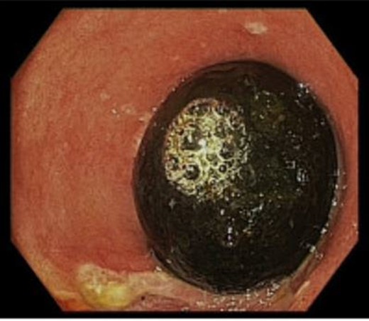 Endoscopic view of gall stone obstructing the pylorus.
