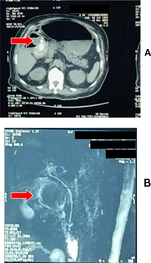 (A) CT scan and (B) MRCP showing a hugely distended stomach with a gallstone obstructing the pylorus.