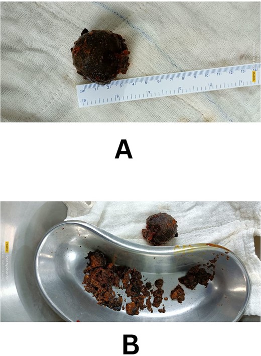 (A and B) Fragmented gallstone after removal.