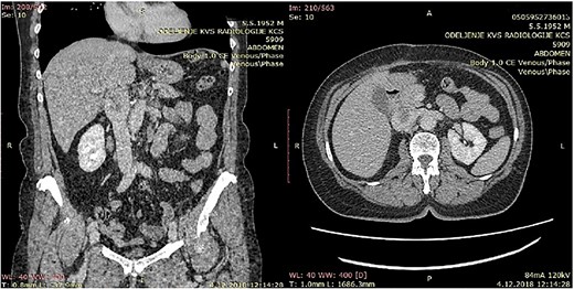 CT of the abdomen that shows a retroperitoneal tumor mass that involves IVC above the renal and under the liver veins.