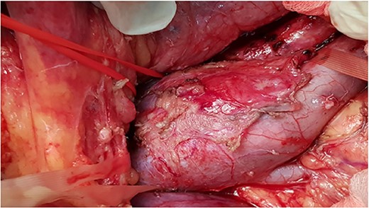 Intra-operative photo showing tumor involve infrarenal segment IVC and level of renal veins.