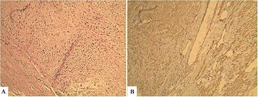 Histopathological findings. Microscopic examination revealed that the tumor consisted of uniform and spindle cells and had a fascicular growth pattern (Hematoxylin & Eosin: ×600) (A). Immunohistochemically staining revealed that α-SMA positive (×600) (B).