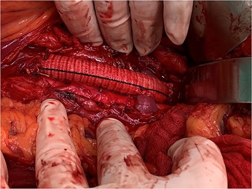 View of the reconstruction IVC with 22 mm Dacron graft and reimplantation left renal vein directly to the graft.