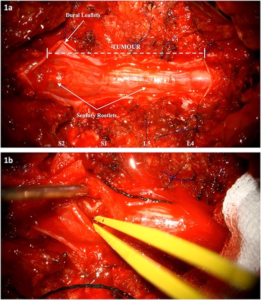 Intraoperative images: (a) Tumour extension from L4 to S2. The dura has been cut and reflected. (b) Internal debulking at the level of S2 whilst respecting the clearly demarcated neural elements. The intrinsic nature of the tumour is noted.