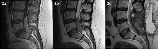 MRI of the spine depicting an intradural lesion between L4-S1. T1-weighted imaging (a) shows heterogeneous enhancement of the lesion upon administration of gadolinium. The lesion is hypointense on T2-weighted imaging (b). Postoperative T2-weighted imaging (c) reveals a small amount of residual tumour.