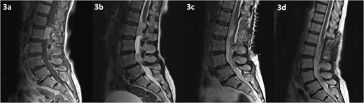 MRI of the spine depicting an intradural lesion at the level of L2, just below the conus. The lesion demonstrates homogenous enhancement on contrast enhanced T1-weighted imaging (a). The lesion is hyperintense on T2-weighted imaging (b). There is no evidence of residual tumour on T2 weighted imaging at 2 days (c) and 14 months (d) postoperatively.