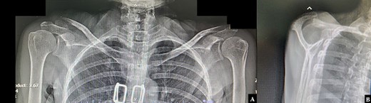 Radiographic (A) anteroposterior views of both clavicles and (B) a lateral transcapular view of the right shoulder revealed a displaced right distal clavicle fracture.