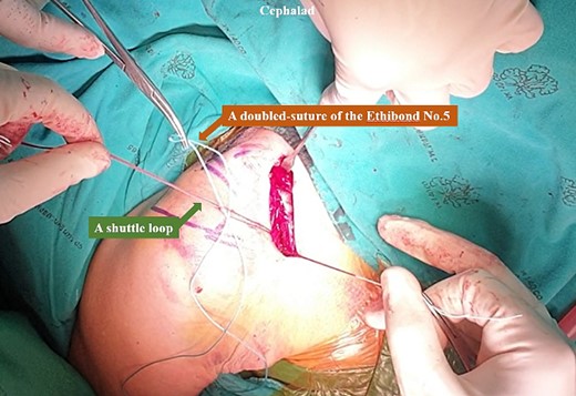 The looped end of the Ethibond No.5 was passed beneath the coracoid base using the shuttle suture technique.