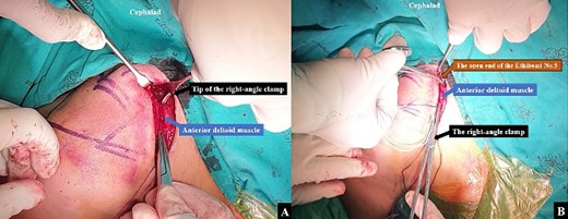 A right angle clamp was utilized to create (A) a tunnel from the coracoid base to the anterior clavicular border of the proximal fragment, following which (B) the looped end of the Ethibond No.5 was then passed from the coracoid base to the anterior clavicular border of the proximal fragment using a right-angle clamp.