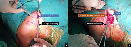A right angle clamp was utilized to create (A) a tunnel from the coracoid base to the posterior clavicular border of the proximal fragment, following which (B) the open end of the Ethibond No.5 was then passed from the coracoid base to the posterior clavicular border of the proximal fragment using a right-angle clamp.