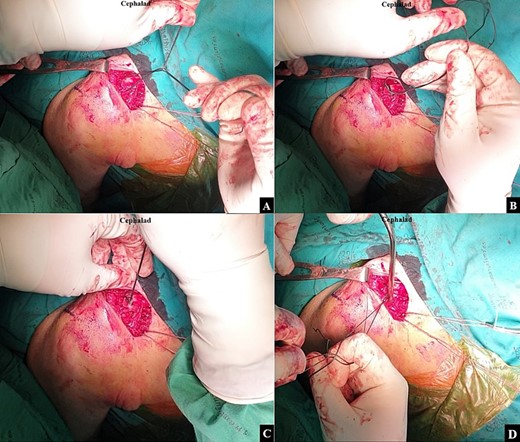 After the doubled-suture of Ethibond No.5 was passed around the coracoid base and proximal fragment of the clavicle, (A) a single square knot was thrown. (B) The two open ends of the Ethibond No.5 were passed through the loop. (C) The knot was dressed and slid down by pulling the two open ends of the Ethibond No.5. (D) A Nice knot was slowly tightened to incrementally slide the proximal fragment to the correct alignment with the distal fragment for the closed reduction.