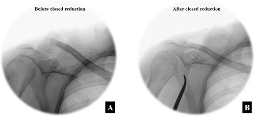 The intra-operative fluoroscope images between (A) before the closed reduction and (B) after the closed reduction with the Nice knot technique in the anteroposterior view.