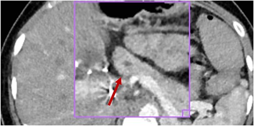 No inflammatory involvement of the body or pancreatic tail is observed; there is no alteration of the peripancreatic fat or collections at this level; visible wirsung canal measures 2.2 mm (red arrow).