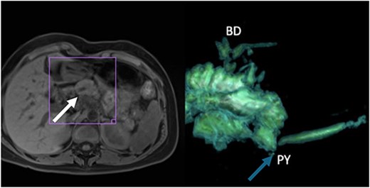 (A) Thickening of the tail of the pancreas with hyperintensity in diffusion sequence (white arrow), anteroposterior diameter 30 mm, inflammatory changes in the body and neck of the pancreas, discreet postcontrast enhancement, and findings suggestive of recurrent interstitial edematous acute pancreatitis; (B) 3D reconstruction with evidence of narrowing of the pancreatojejunal anastomosis (blue arrow).