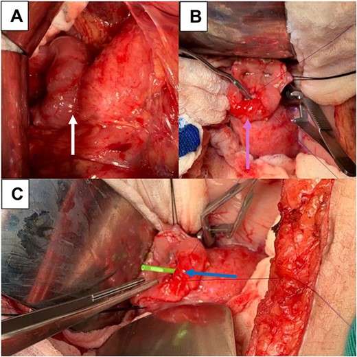 (A) Pancreato-jejunal anastomosis (white arrow); (B) enterotomy, mechanical dilation of the PJ anastomosis, and plasty (light blue arrow); (C) placement of plastic stent in PY anastomosis (blue arrow).