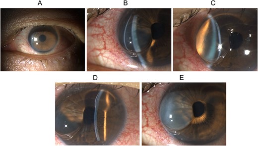Slit lamp biomicroscopy of the left eye on presentation and upon wound burping: (A) diffuse illumination of the anterior segment showing conjunctival hyperemia, diffuse corneal haze, and microcystic epithelial edema; (B) direct focal illumination using a slit beam coming from the examiner’s left side showing separation of the corneal epithelium from the underlying corneal stroma in the nasal half of the cornea; (C) direct focal illumination using a slit beam coming from the examiner’s right side showing the huge corneal epithelial detachment in the nasal half of the cornea, and the detached epithelium is relatively clear in the first minute after the wound burping, and (D) direct focal illumination using a slit beam coming from the examiner’s left side showing separation of the corneal epithelium from the underlying corneal stroma in the superior quarter of the cornea; the C-shaped corneal epithelial detachment is clearly seen, and (E) diffuse illumination of the anterior segment showing the detached corneal epithelium had turned hazy in the second minute after the wound burping.