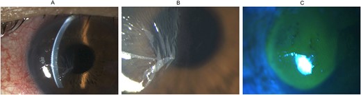Slit lamp biomicroscopy and fluorescein staining of the left eye after bursting of corneal epithelial bulla: (A) direct focal illumination using a slit beam coming from the examiner’s left side showing the corneal epithelium resting on the underlying corneal stroma in the nasal half of the cornea after the corneal epithelial bulla had burst; (B) diffuse illumination of the anterior segment showing redundant folds of corneal epithelium after the epithelial bulla had burst; (C) cobalt blue light examination after instillation of fluorescein sodium showing fluorescein staining of the deflated bulla.