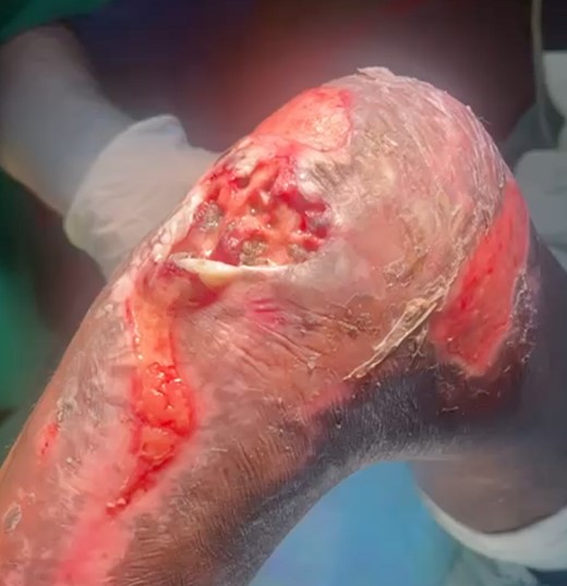 Skin lesion upon presentation.