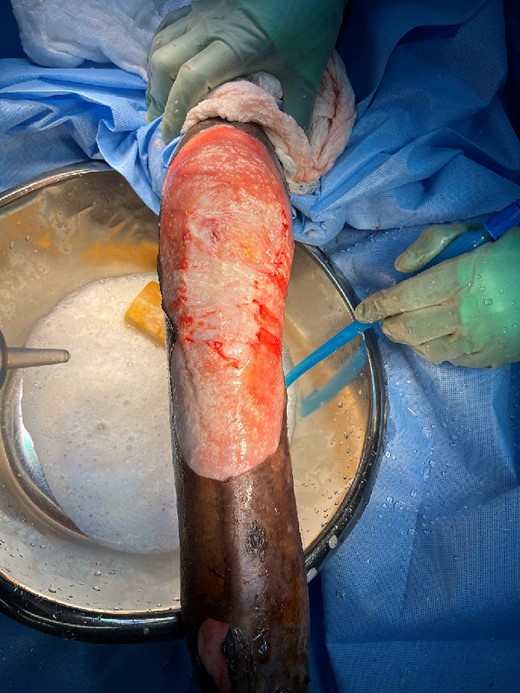 Intraoperative image after extensive debridement.