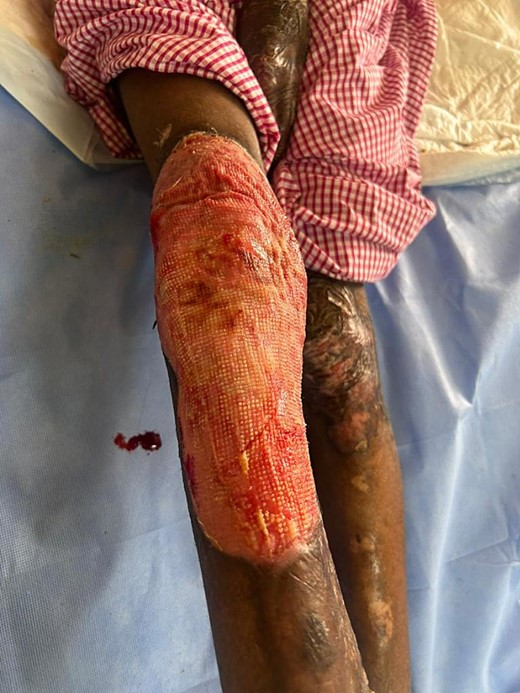 Suffocation therapy was started with application of thick layer of petroleum jelly.