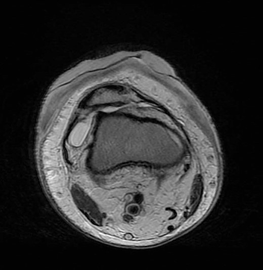 MRI showed no intra-articular involvement.
