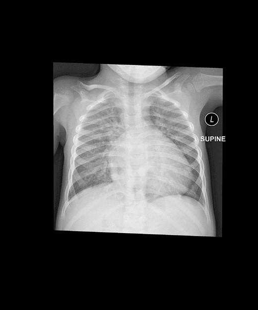 This is a preoperative chest X-ray with an AP view revealing subtle lucent mediastinal structures in the lower mid-chest.