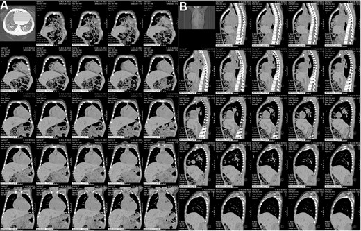 These CT chest scans in the coronal (A) and sagittal (B) planes, showing an anterior central diaphragmatic defect measuring 4.3 cm × 2.8 cm (TR × AP) with intrathoracic herniation of part of the transverse colon.