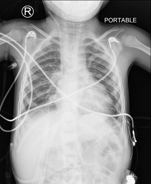 This is a postoperative AP view of chest X-ray showing the disappearance of the abnormal mediastinal lucency representing loops of bowel.