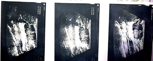 Breast ultrasonography.