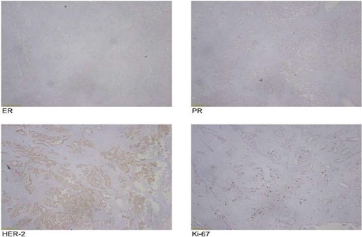 Pathological staging of tumor.