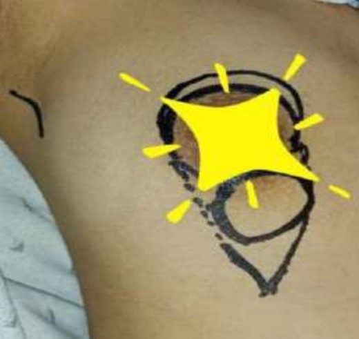 Mastectomy procedure (incision outline).