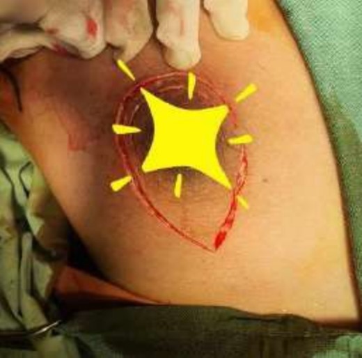 Mastectomy procedure (Elliptical Incision given around nipple).