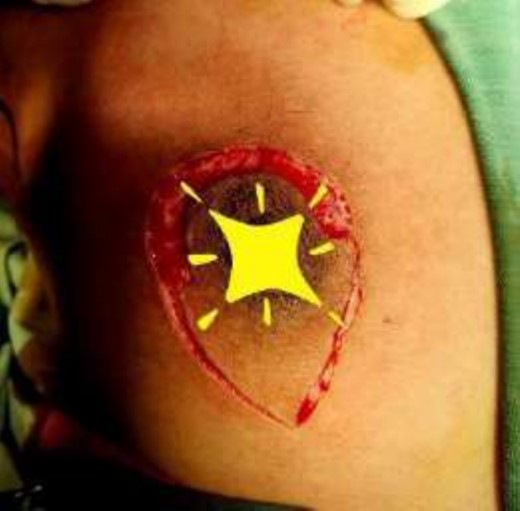 Mastectomy procedure (Nipple Flap Created).