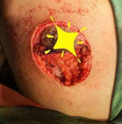 Mastectomy procedure (Nipple Flap Removal).
