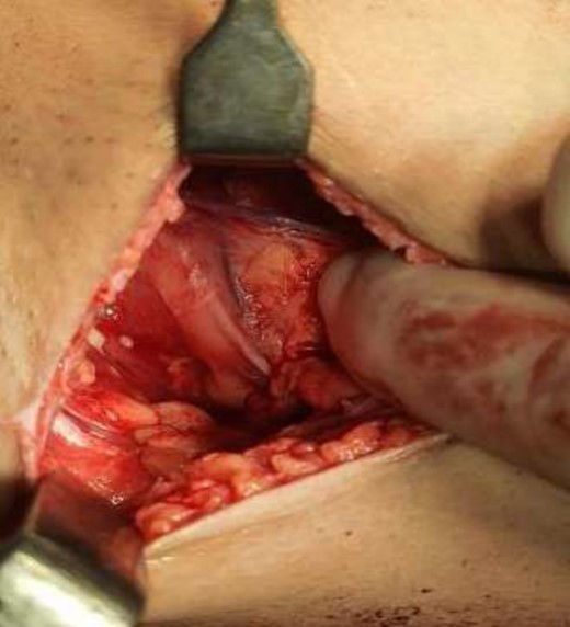 Mastectomy along with sentinel lymph node biopsy procedure (Tumor Approach).