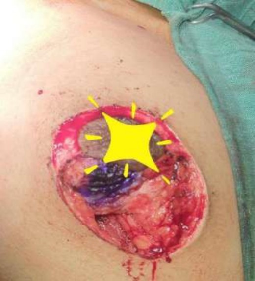 Mastectomy along with sentinel lymph node biopsy procedure (Sentinel Lymph node Biopsy).