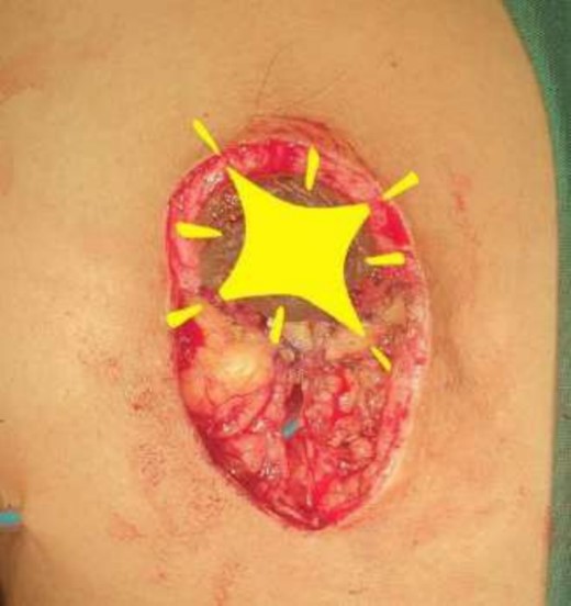 Mastectomy along with sentinel lymph node biopsy procedure (Tumor extracted).