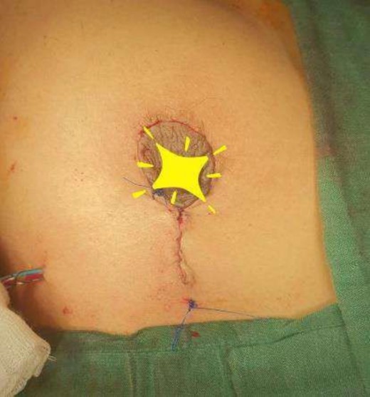 Vertical mastopexy.