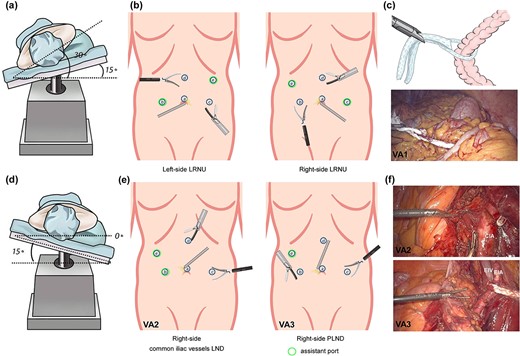 Diagram of patient positions, trocar placement, and the use of cotton cord for surgical exposure. (a) Patient position for right-side LRNU. (b) Trocar placement for LRNU. For each lesion side, the right-hand port of the surgeon is for ultrasonic scalpel. (c) A cotton cord was used to wrap around the descending colon, and a grasping forcep was inserted by port b to retract the bowel medially away from the surgical field. (d) Patient position for right-side PLND and bladder cuff excision. (e) Trocar placement for common iliac vessels LND, PLND and bladder cuff excision. (f) Visual angles for common iliac vessels LND and PLND. A cotton cord was used to sling the external iliac vessels. CIA: common iliac artery; EIA: external iliac artery; EIV: external iliac vein.