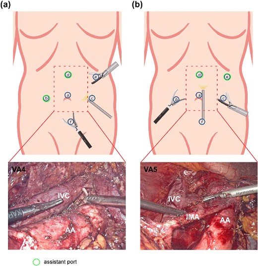 Diagram of patient positions, trocar placement, and the use of cotton cord for surgical exposure. (a) Patient position for right-side LRNU. (b) Trocar placement for LRNU. For each lesion side, the right-hand port of the surgeon is for ultrasonic scalpel. (c) A cotton cord was used to wrap around the descending colon, and a grasping forcep was inserted by port b to retract the bowel medially away from the surgical field. (d) Patient position for right-side PLND and bladder cuff excision. (e) Trocar placement for common iliac vessels LND, PLND and bladder cuff excision. (f) Visual angles for common iliac vessels LND and PLND. A cotton cord was used to sling the external iliac vessels. CIA: common iliac artery; EIA: external iliac artery; EIV: external iliac vein.