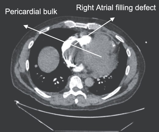 CTPA showing oval-shaped heterogenous lesion as well as RA filling defect.