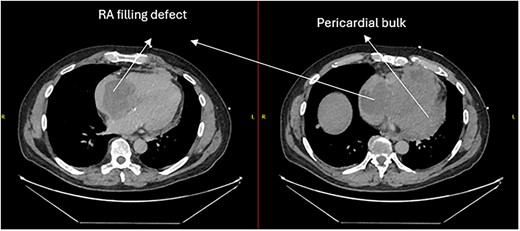CT thorax-abdomen pelvis, depicting the RA filling defect as well as pericardial bulk.