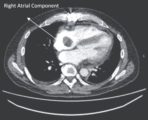 Post-operative CT scan during chemotherapy showing reduction of size RA bulk.