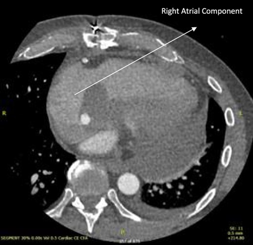 Post-operative CT scan showing further reduction of RA bulk following chemotherapy.