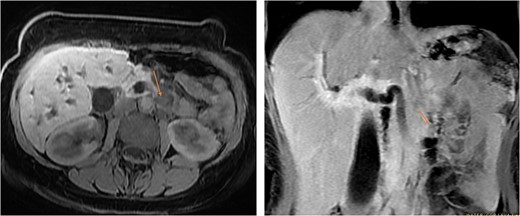 MRI in axial and sagittal views shows the location of the AOV tumor, as pointed out by the arrows.